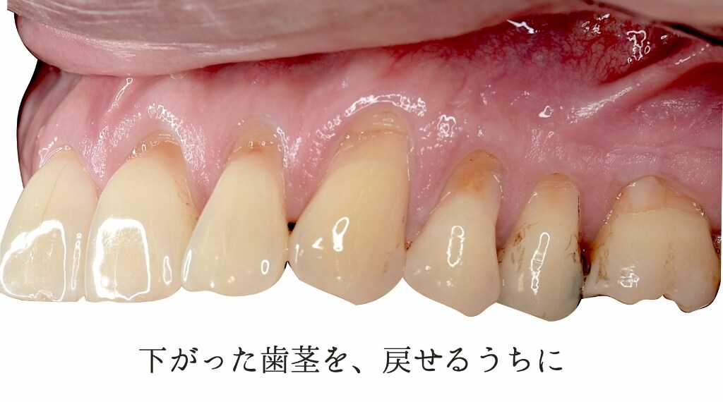 下がった歯茎を、戻せるうちに