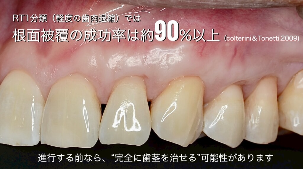 RT1分類（軽度の歯肉退縮）では、根面被覆の成功率は約90%以上 進行する前なら、完全に歯茎を治せる可能性があります