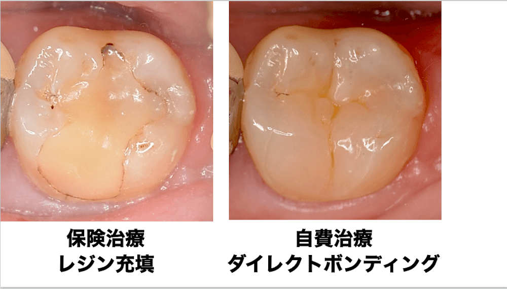 ダイレクトボンディングで後悔しないために|デメリット・寿命・失敗しやすいケースを歯科医が解説