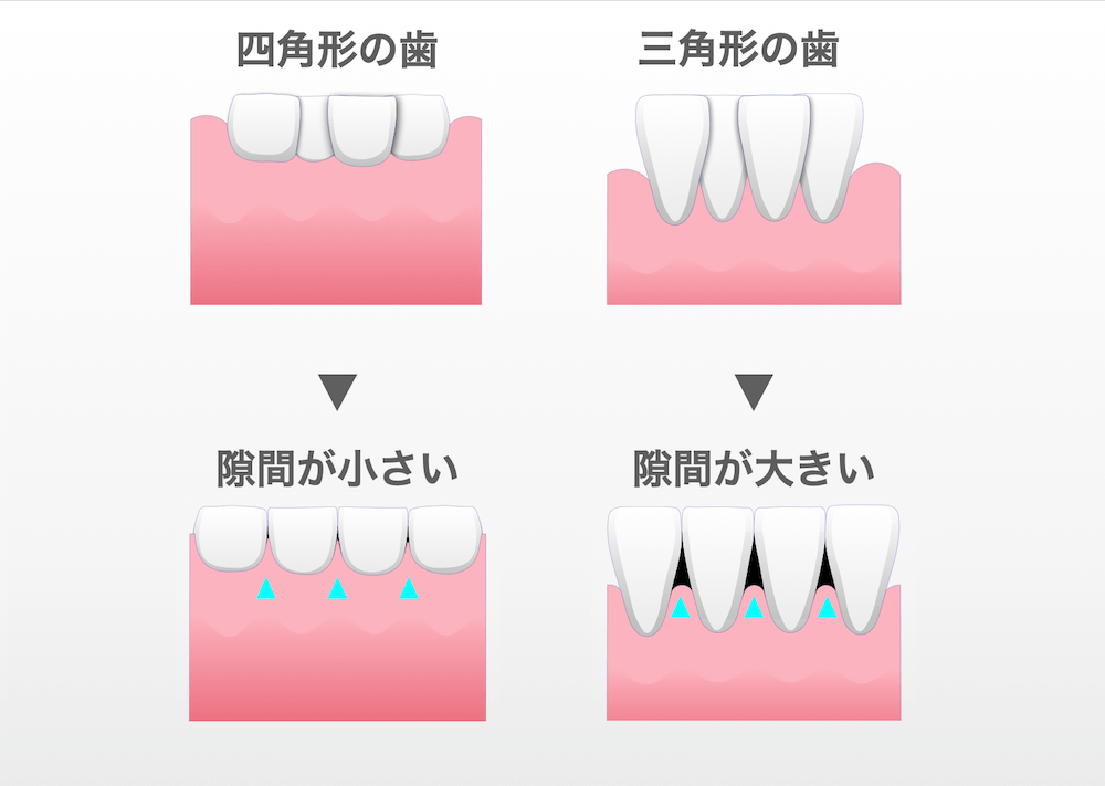 ①下顎の前歯の叢生 三角形の長い歯はブラックトライアングルが出現しやすい