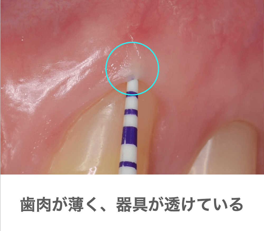 1mm以下の厚さの歯肉では歯周ポケットに挿入した器具が透けて見えます。