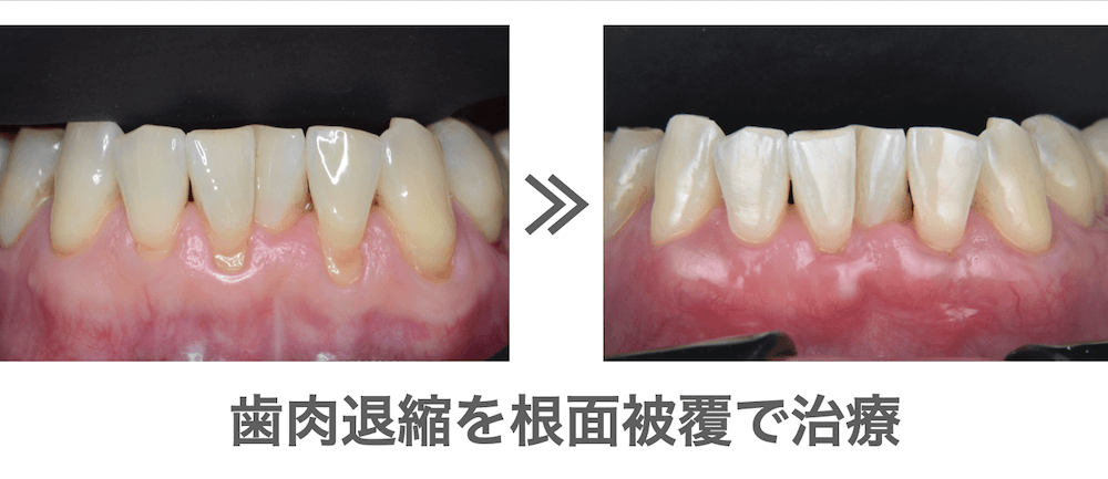 歯周外科的治療 根面被覆