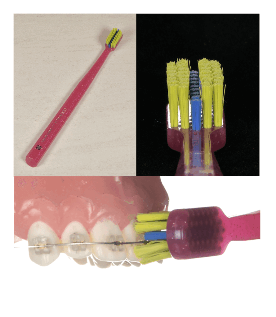 矯正中のセルフケアについて