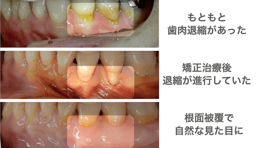 矯正すると歯茎が下がりやすい?