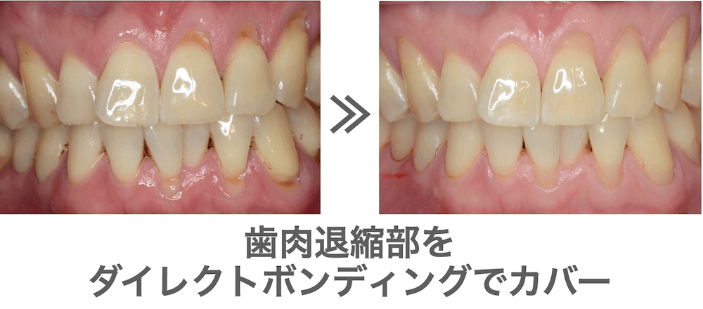歯肉退縮部をダイレクトボンディングでカバー