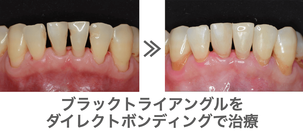 ダイレクトボンディングで回復する方法