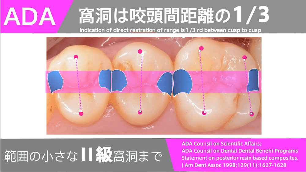 ADA 窩洞は咬頭間距離の1/3 Indication of direct restration of range is 1/3 rd between cusp to cusp 範囲の小さなⅡ級窩洞まで ADA Counsil on Scientific Affairs; ADA Counsil on Dental Dental Benefit Programs Statement on posterior resin based composites. J Am Dent Assoc 1998;129(11):1627-1628