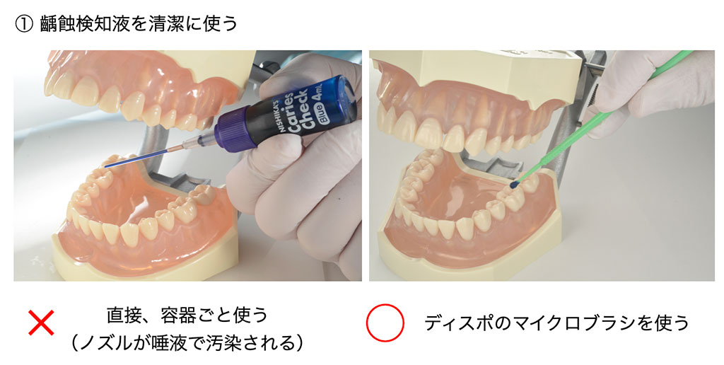 ① フロワブルレジンのノズルをディスポにして患者さんごとに変えています。
