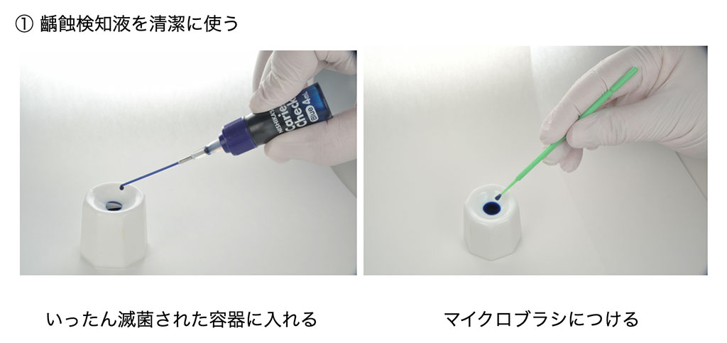 ① 齲蝕検知液を清潔に使う × 直接、容器ごと使う(ノズルが唾液で汚染される) ○ ディスポのマイクロブラシを使う