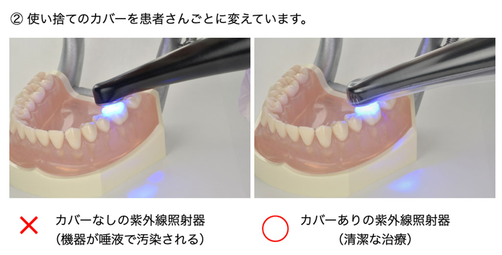 ① 齲蝕検知液を清潔に使う いったん滅菌された容器に入れる/マイクロブラシにつける