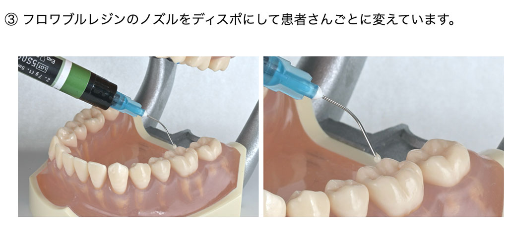 ② 使い捨てのカバーを患者さんごとに変えています。 × カバーなしの紫外線照射器(機器が唾液で汚染される) ○ カバーありの紫外線照射器(清潔な治療)