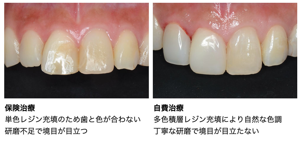前歯の仕上がり比較(左:保険治療/右:自費治療)。保険治療は、単色レジン充填のため歯と色が合わない/研磨不足で境目が目立つ。自費治療は、多色積層レジン充填により自然な色調/丁寧な研磨で境目が目立たない。