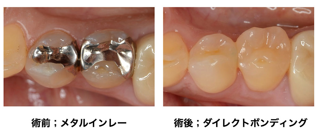 左:術前メタルインレー 右:術後ダイレクトボンディング