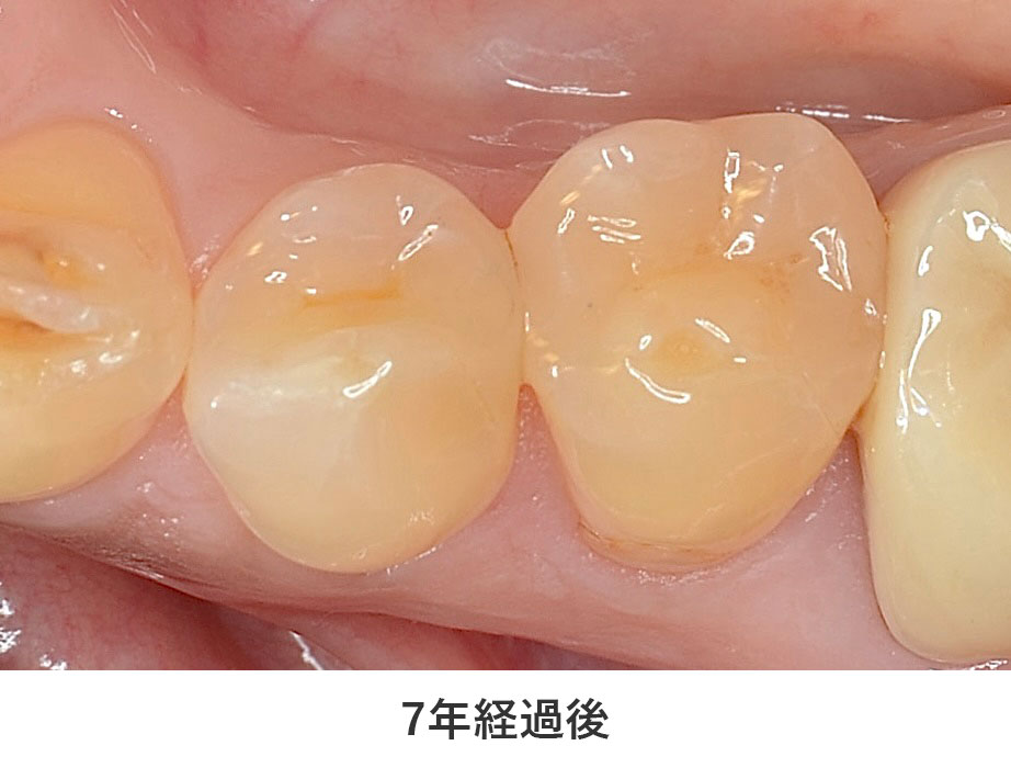 7年経過後