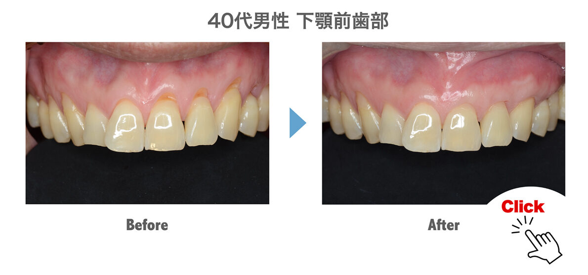 ４０代男性　上顎前歯部