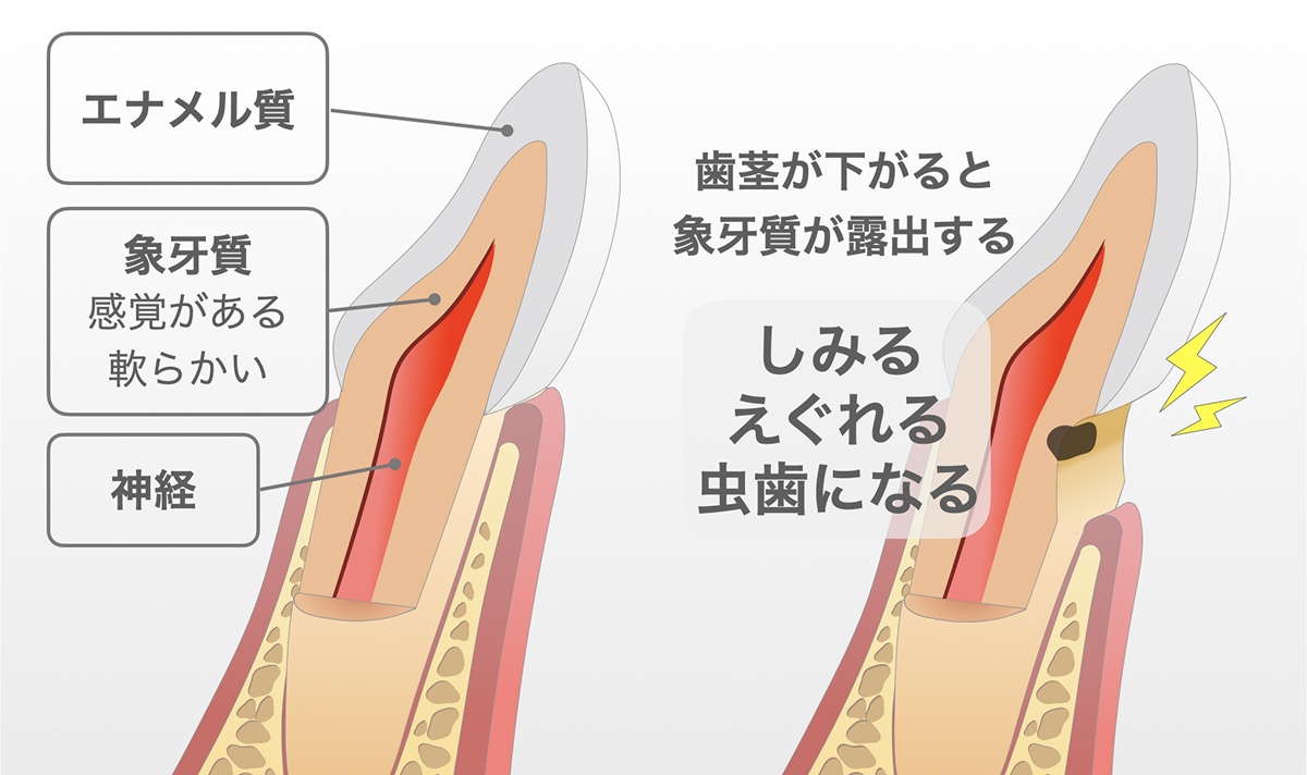 歯の断面構造を示した図。左はエナメル質・象牙質・神経の位置関係を説明し、右は歯茎が下がって象牙質が露出することで、しみる・えぐれる・虫歯になるリスクが高まる様子を示している。