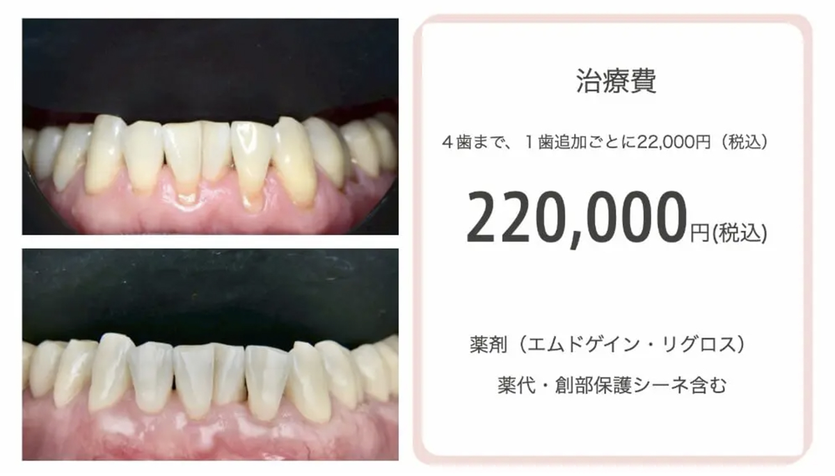 治療費 4歯まで、1歯追加ごとに22,000円（税込）220,000MBi 薬剤（エムドゲイン・リグロス） 薬代・創部保護シーネ含む