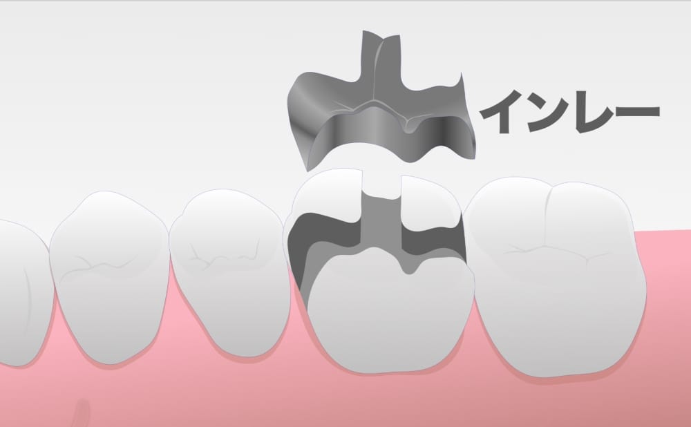 image_tooltip インレー