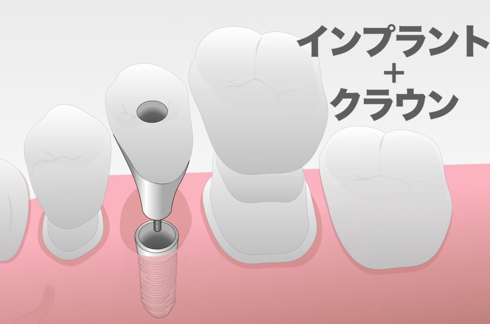 image_tooltip インプラント・クラウン