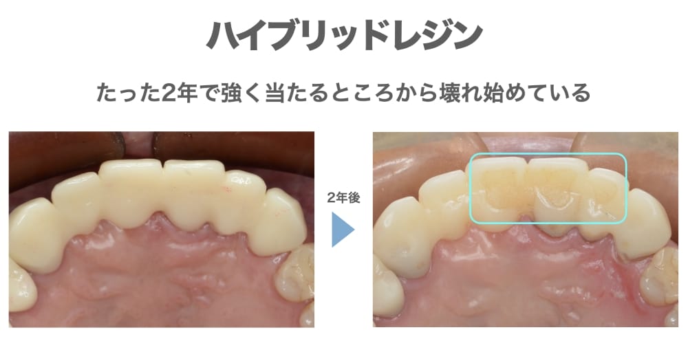 image_tooltip ハイブリッドレジン