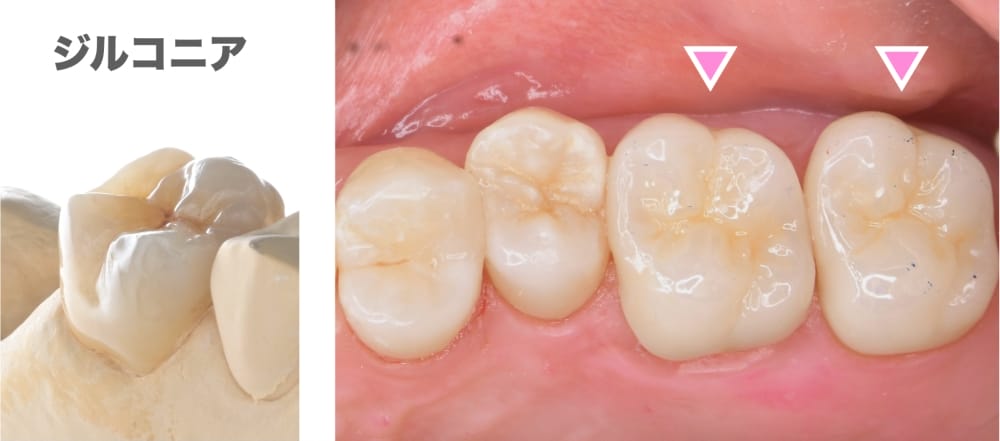 image_tooltip ジルコニア