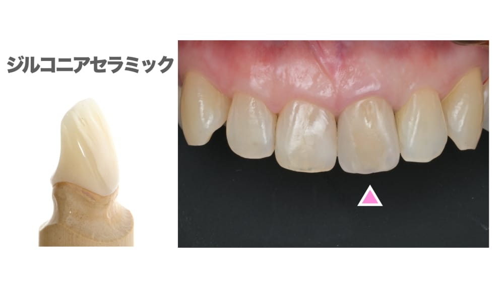 image_tooltip ジルコニアセラミック