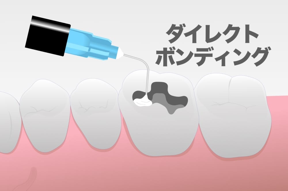 image_tooltip ダイレクトボンディング