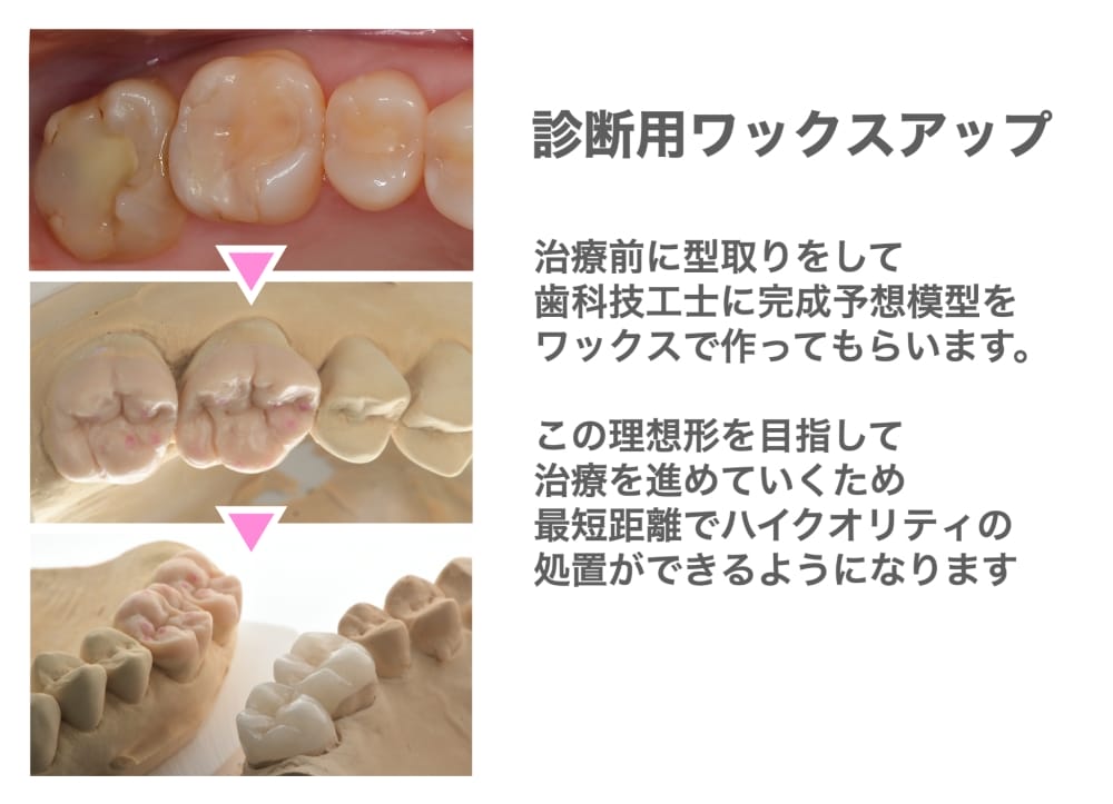 image_tooltip 診断用ワックスアップ