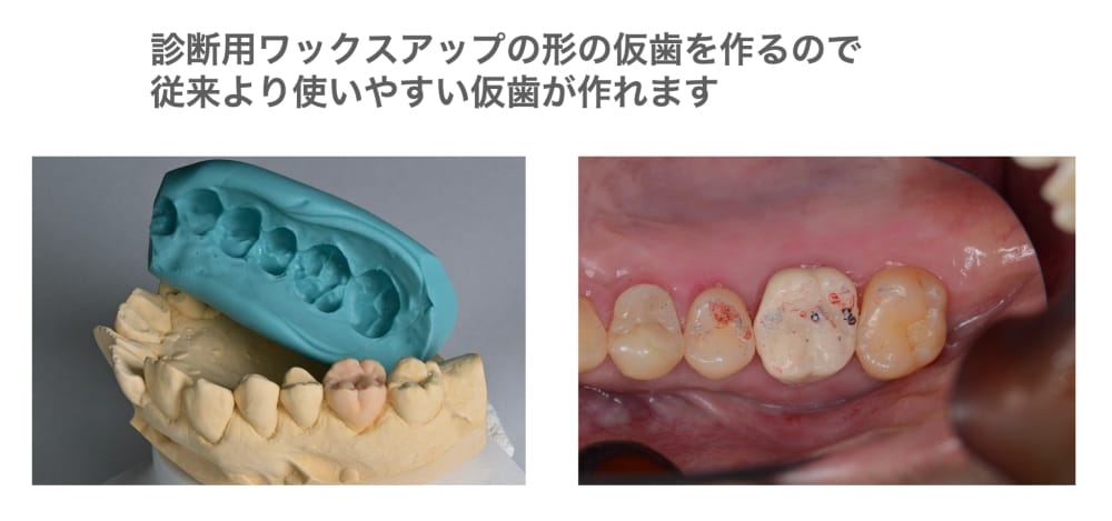 image_tooltip 従来より使いやすい仮歯