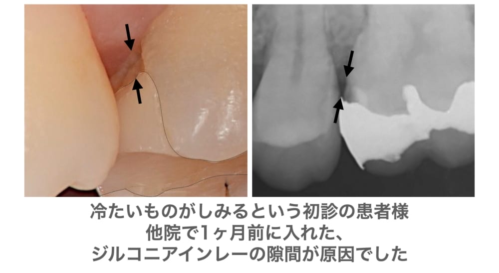 image_tooltip ジルコニアインレーの隙間