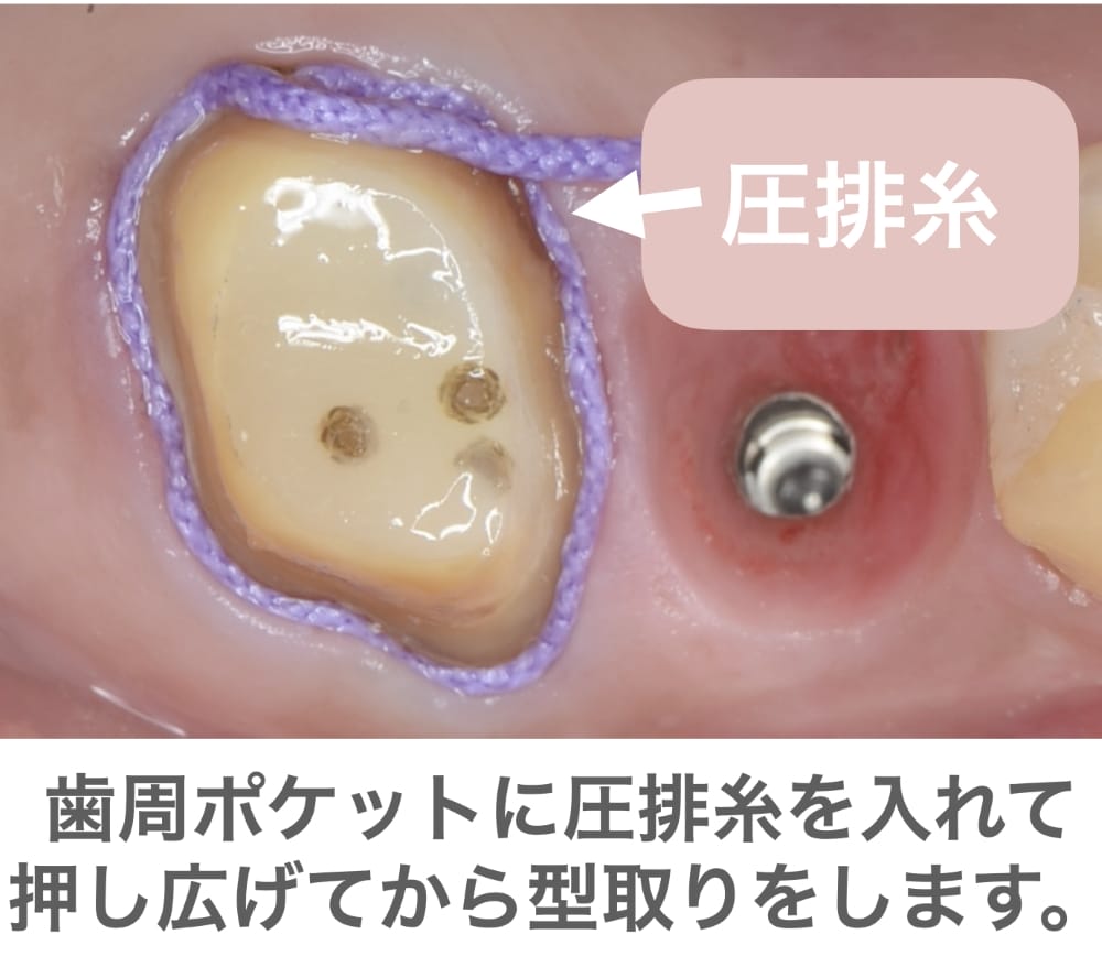 image_tooltip 高精度の型取り