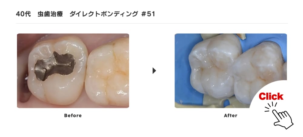 image_tooltip 虫歯治療ダイレクトボンディング