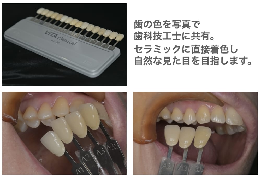 image_tooltip 自然な見た目のセラミック