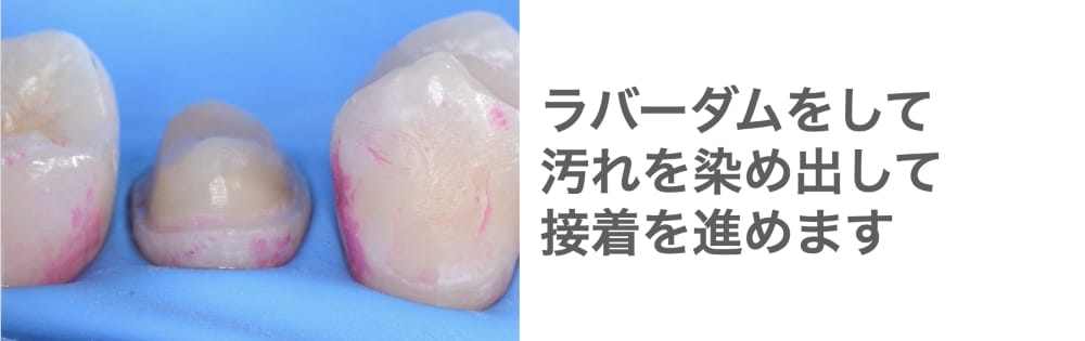 image_tooltip ラバーダムを装着した様子