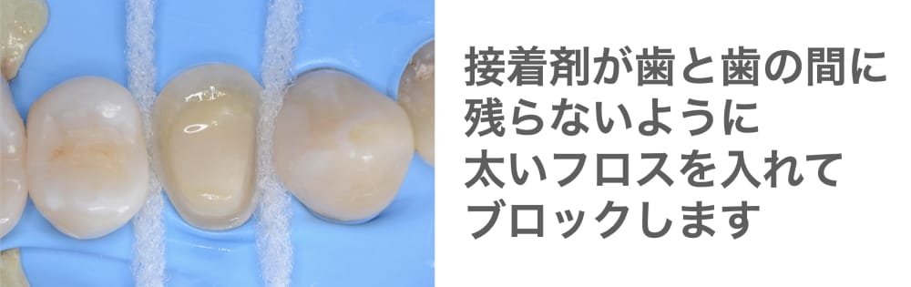 image_tooltip 歯と歯の間に太いフロスを入れる様子