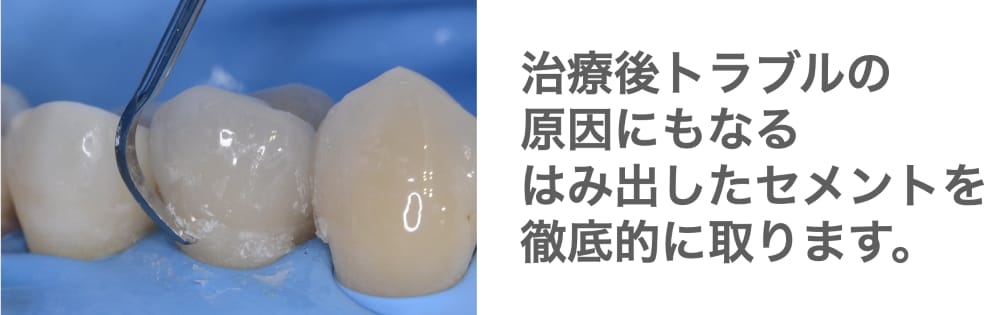 image_tooltip はみ出したセメントを取る様子