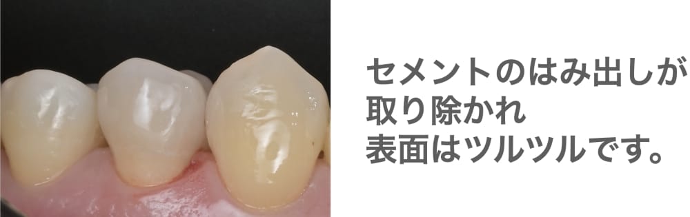 image_tooltip 表面がツルツルの歯