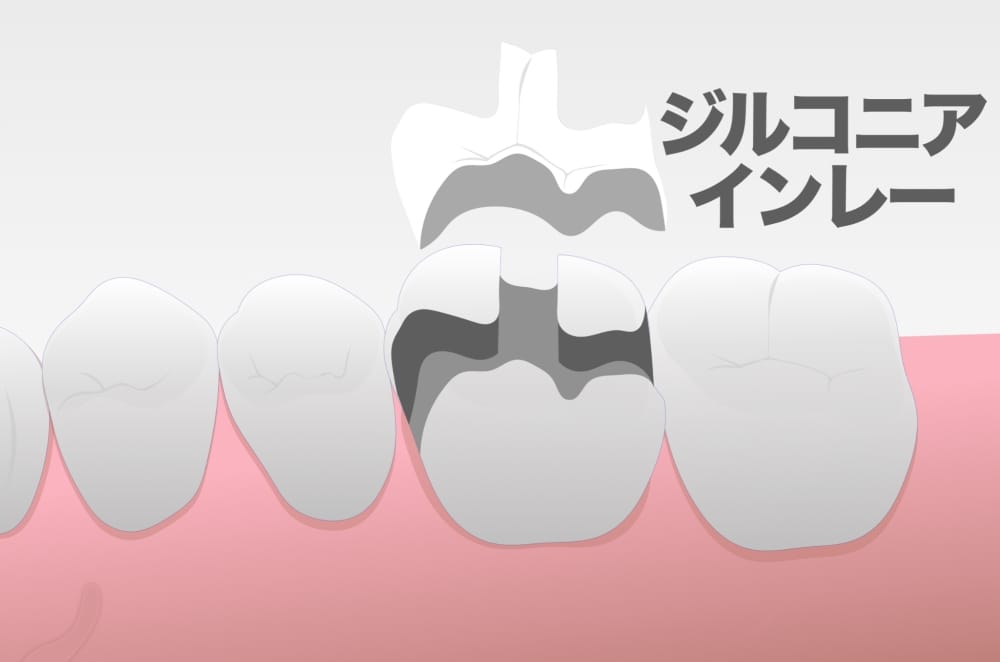 image_tooltip ジルコニアインレー