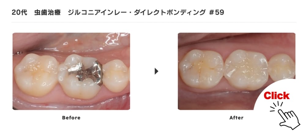 image_tooltip ジルコニアインレー・ダイレクトボンディング