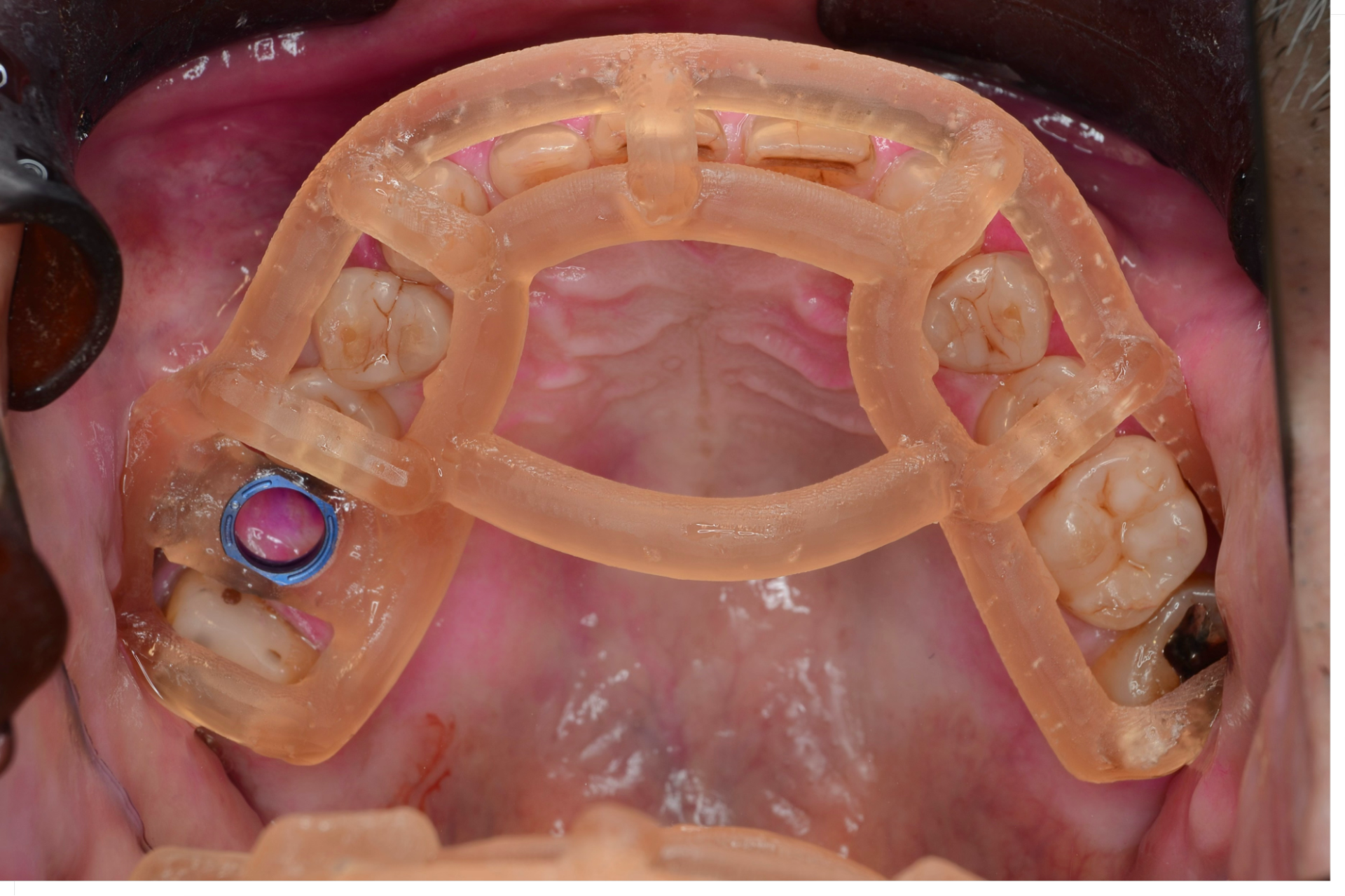 SMOPガイドを装着したところ
