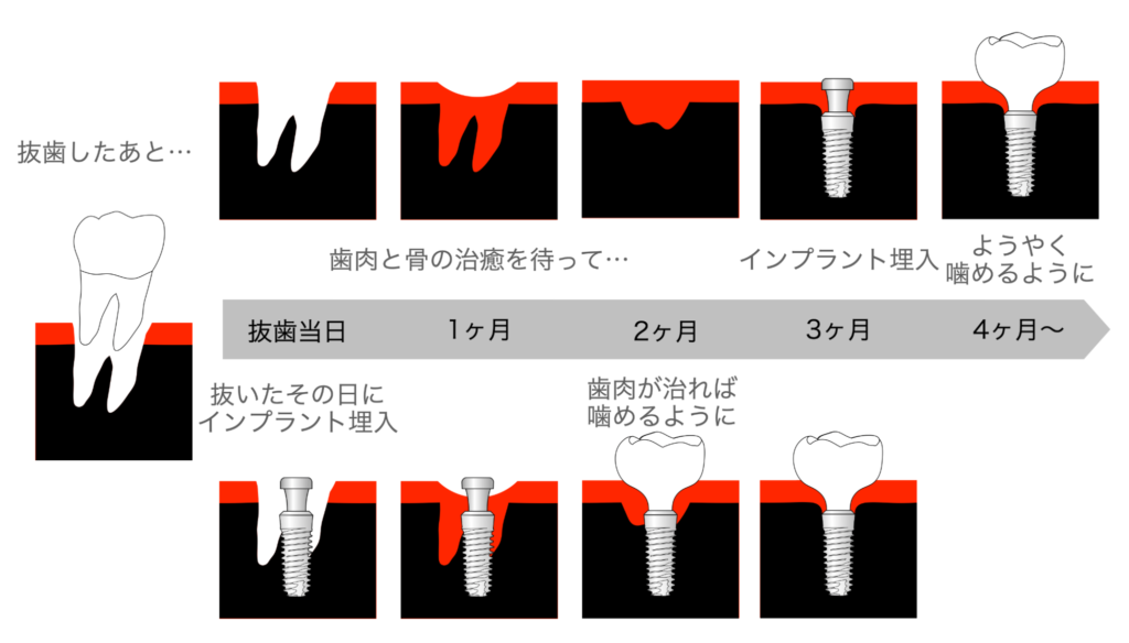 抜歯即時インプラントで心身の負担を抑える