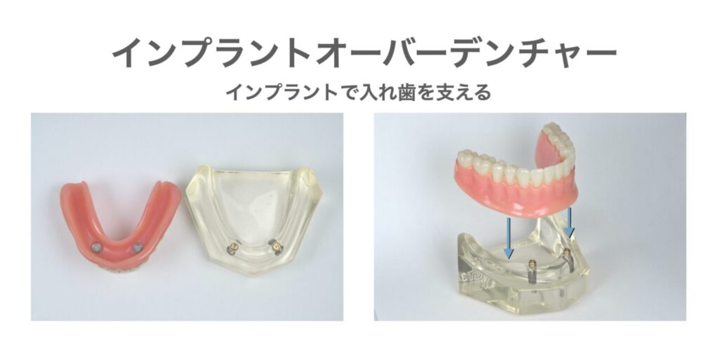 インプラントオーバーデンチャー
