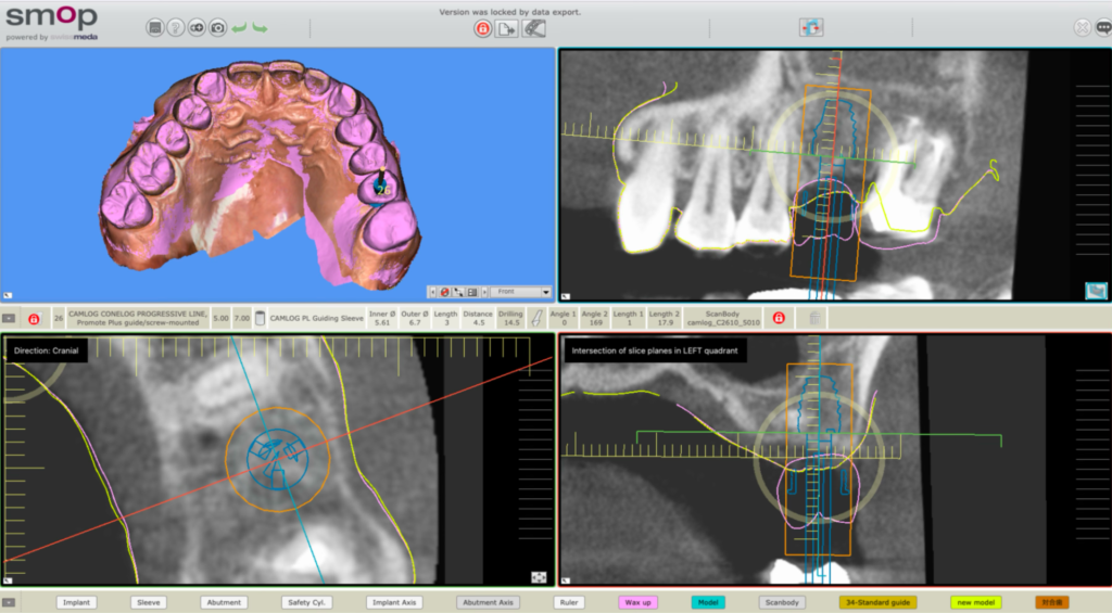 シミュレーションで決めた位置・角度を、ガイドで再現する