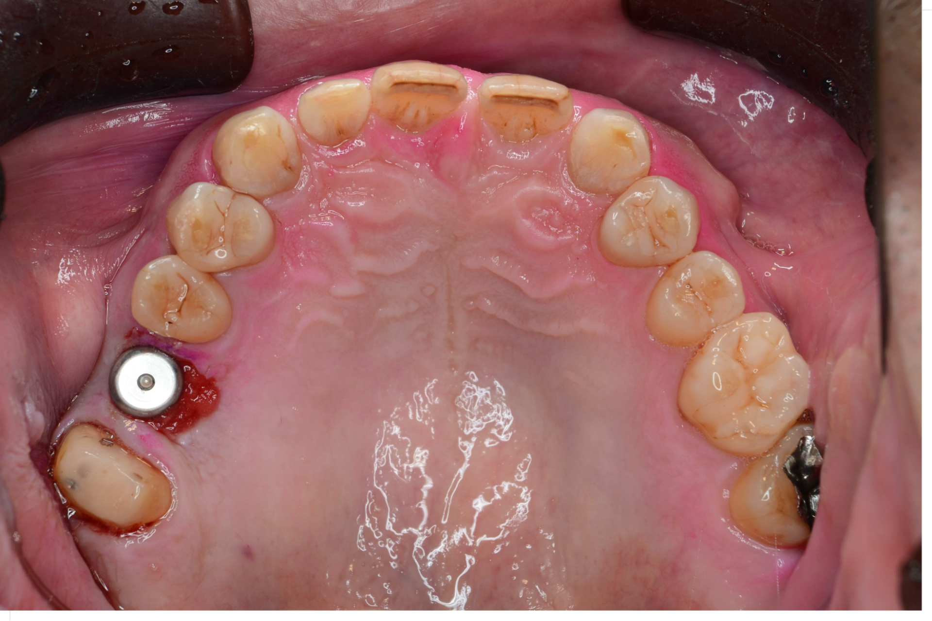 予定の位置に埋入されたインプラント
