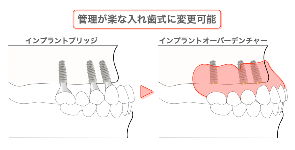 管理が楽な入れ歯式に変更可能
