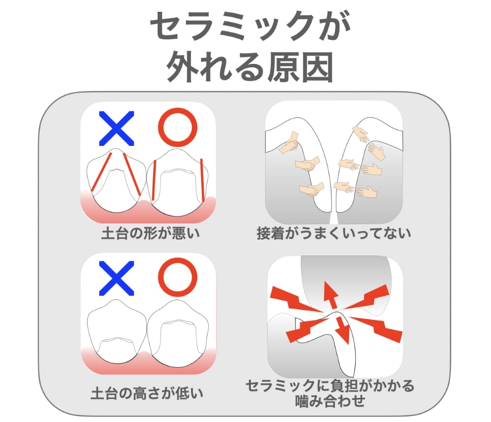 セラミックが外れる原因