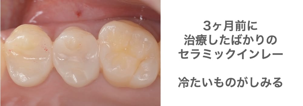 セラミックインレー冷たいものが染みる