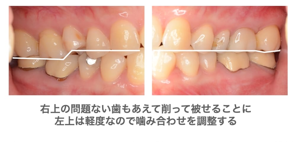 セラミック治療