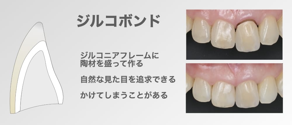 ジルコボンド