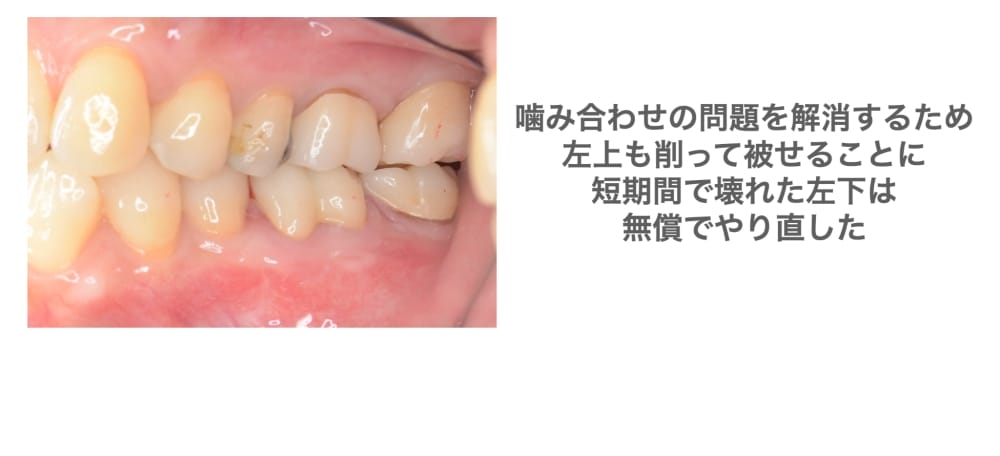 噛み合わせの問題解消